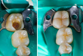 Tooth Coloured fillings 2